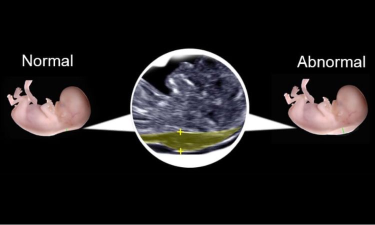 nuchal-translucency-nt-scan